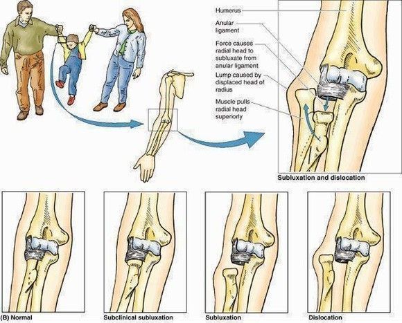 Ne tire pas sur mes bras